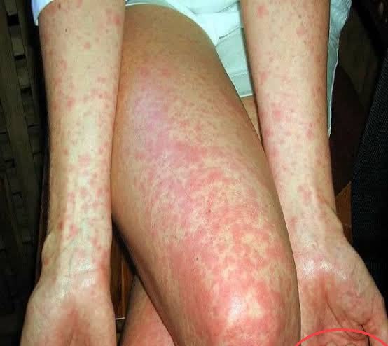 Pernas com manchas vermelhas e lesões avermelhadas causadas por infecção cutânea bacteriana